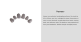 Veneer